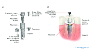 Implantation image