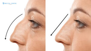 What You Need to Know Before Getting a Nose Surgery