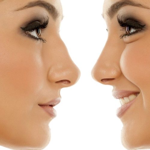 How to Choose the Right Rhinoplasty for Your Face Shape?