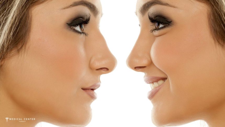 How to Choose the Right Rhinoplasty for Your Face Shape?