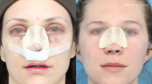 What You Need to Know Before Getting a Nose Surgery