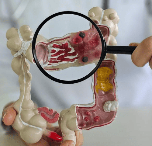 Removal of Colon Cancer Removal of Colon Cancer