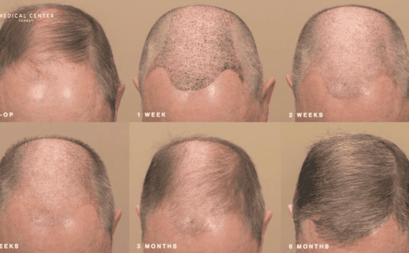 How Long Is the Hair Transplant Recovery Time?