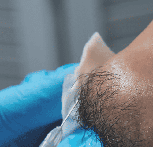 Beard Transplant in Turkey: Lower Cost, Top Care