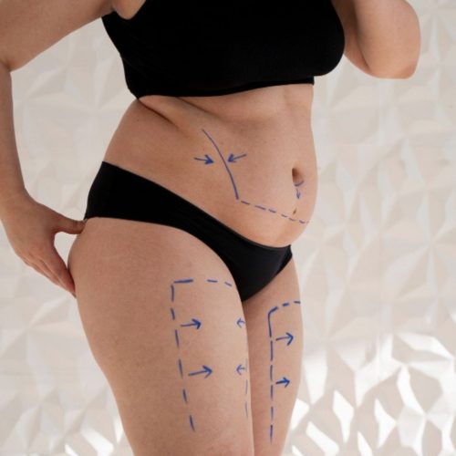 Liposuction in Turkey: Types, Prices, Procedures