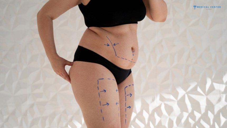 Liposuction in Turkey: Types, Prices, Procedures