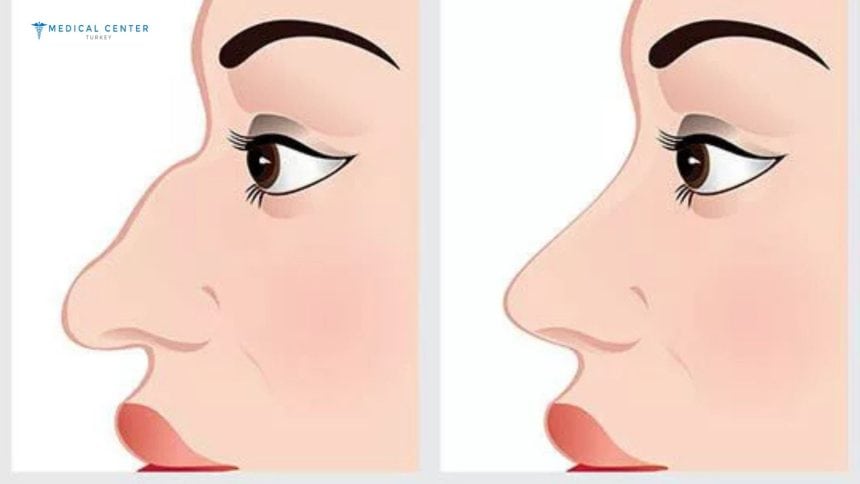 Rhinoplasty in Turkey: Types, Prices, Procedures