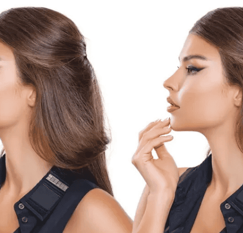 Is Turkey the Best Destination for Rhinoplasty in 2026?