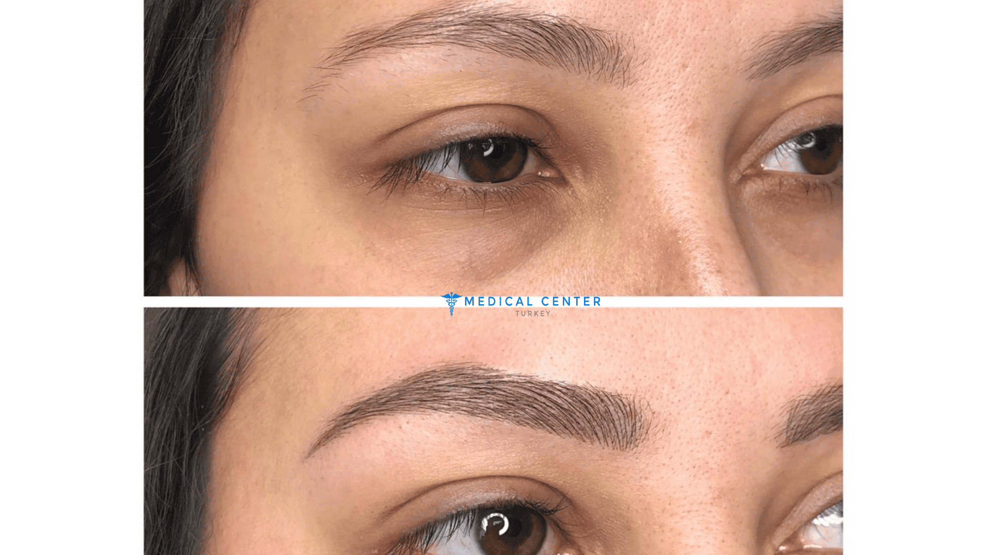Microblading in Turkey: Types, Prices, Procedures - Medical Center Turkey