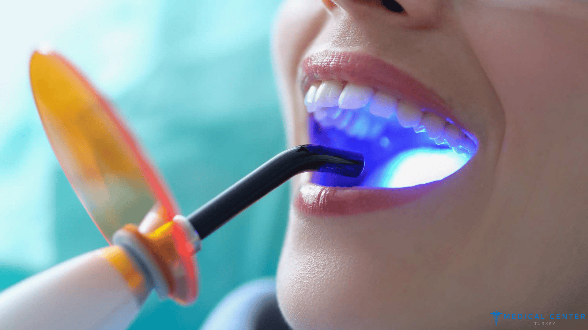 What to Know Before Getting a Dental Makeover in Turkey 2025