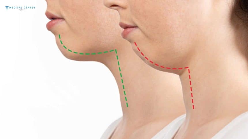 How Much Does Jaw Surgery Cost in Turkey? How Much Does Jaw Surgery Cost in Turkey?