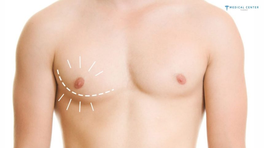 Gynecomastia in Turkey at a Glance Gynecomastia in Turkey at a Glance