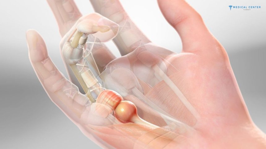 Trigger Finger Correction in Turkey Trigger Finger Correction in Turkey