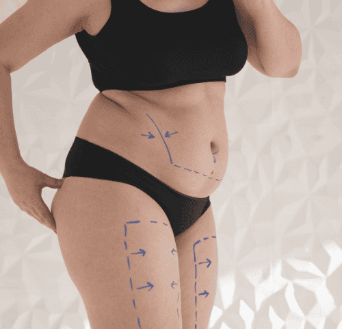 Why Liposuction in Turkey is the Best Option for You?