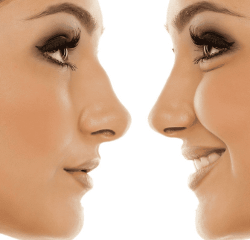 The Benefits of Non-Invasive Rhinoplasty in 2025