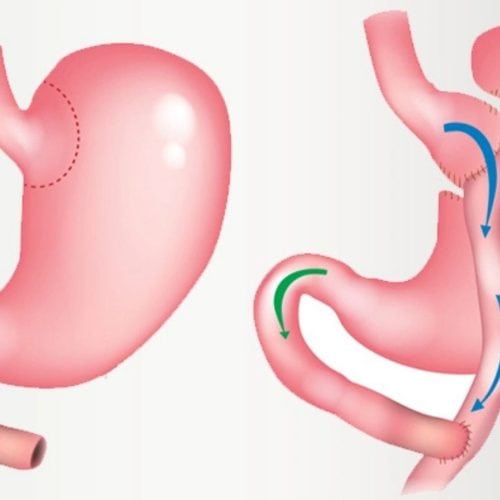 Are you Eligible for Gastric Bypass Surgery in Turkey?