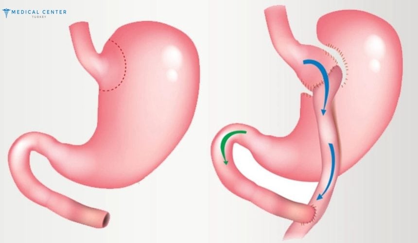 Are you Eligible for Gastric Bypass Surgery in Turkey? Are you Eligible for Gastric Bypass Surgery in Turkey?