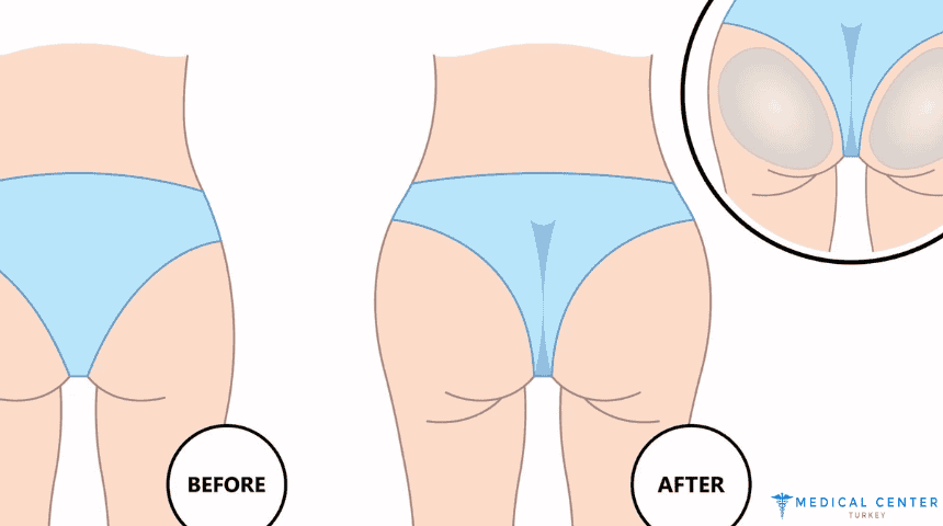 Butt Lift Surgery in Turkey 2025