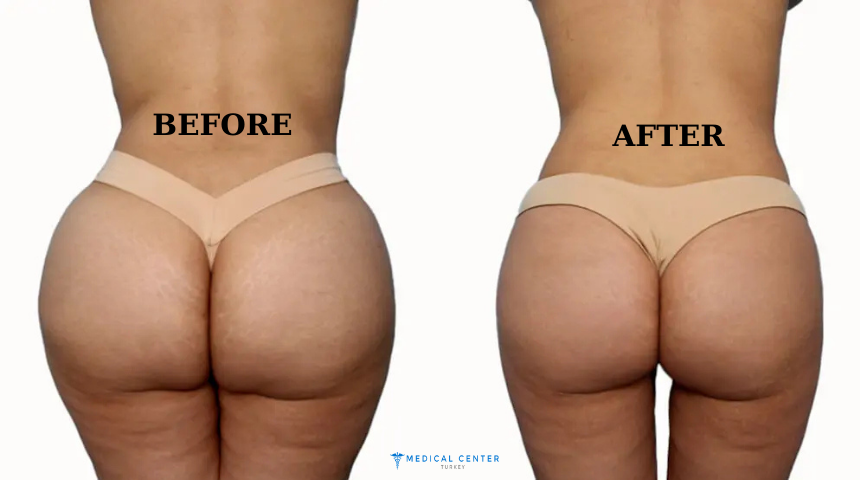 Butt Lift Surgery in Turkey in 2025