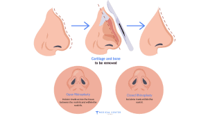 Is Rhinoplasty in 2025 Safer Than Ever?