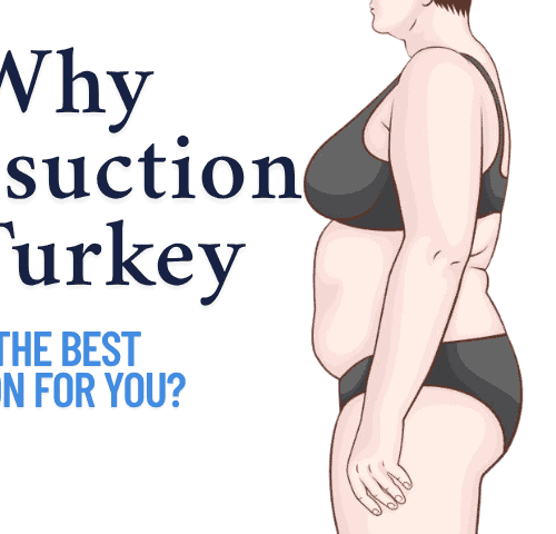 Why Liposuction in Turkey is the Best Option for You?