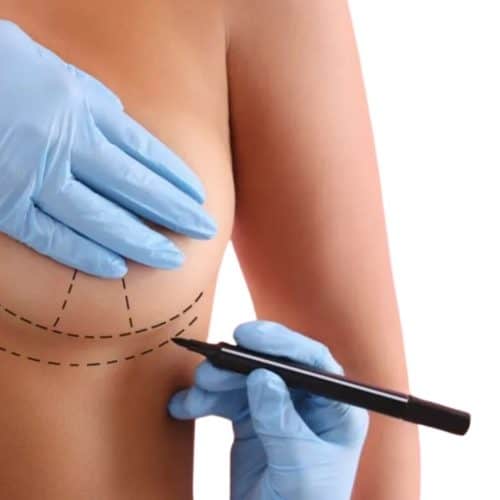 Is Breast Augmentation Still a Popular Choice for 2025?