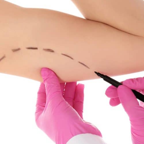 Mini Arm Lift 2025: A Quick Fix for Sagging Skin