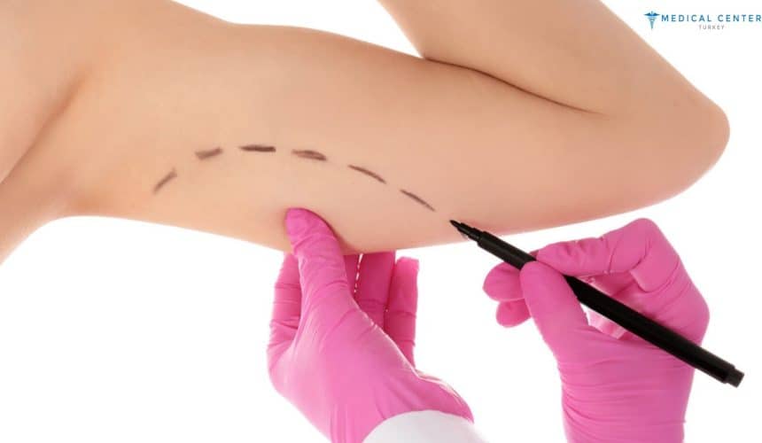 Mini Arm Lift 2025: A Quick Fix for Sagging Skin Mini Arm Lift 2025: A Quick Fix for Sagging Skin