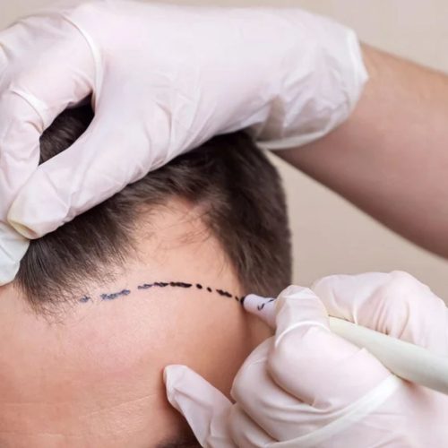 Why Do People Go to Turkey for Hair Transplant?