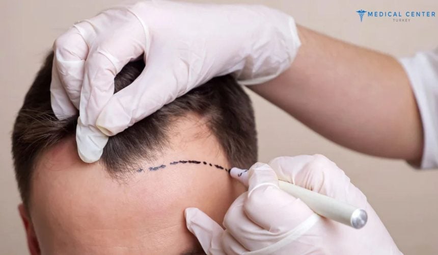 Why Do People Go to Turkey for Hair Transplant? Why Do People Go to Turkey for Hair Transplant?