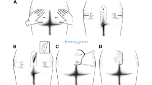 Cleft Lift Surgery What’s the Procedure Like in 2025 2