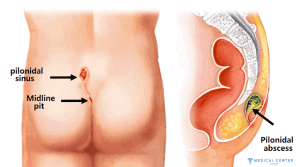 Cleft Lift Surgery What’s the Procedure Like in 2025 3