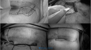 Cleft Lift Surgery What’s the Procedure Like in 2025 2