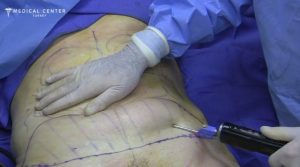 Simple Guide to Liposuction in Turkey 2025