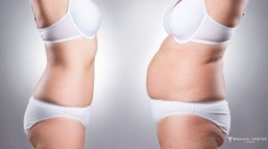 Simple Guide to Liposuction in Turkey 2025
