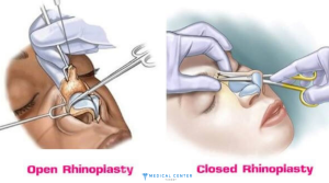 The Pros and Cons of Rhinoplasty Surgery Abroad in 2025 