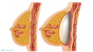 The Ultimate Guide to Recovery After Breast Augmentation in 2025