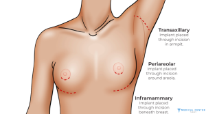The Ultimate Guide to Recovery After Breast Augmentation in 2025