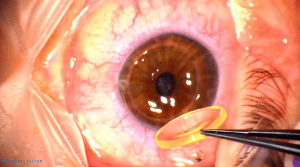 Transplant Surgery in Turkey 2025