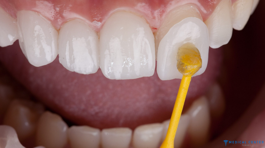 What to Know Before Getting a Dental Makeover in Turkey 2025