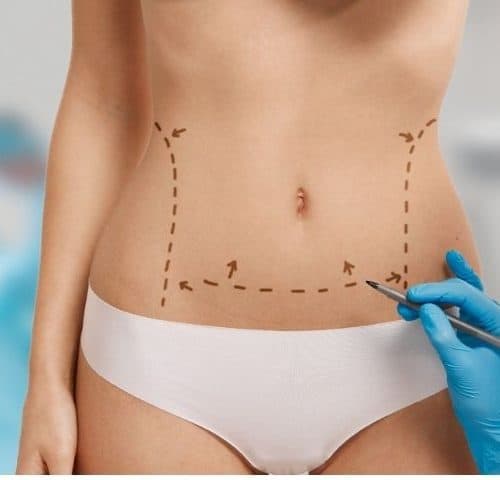 What Are the Risks Involved in Liposuction?