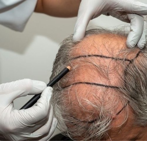 Understanding the Different Types of Hair Transplants and Which One Is Best?