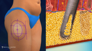 Why is Everyone Talking About Liposuction in Turkey?