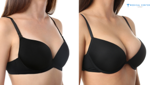 Why Breast Augmentations are Trending in 2026?