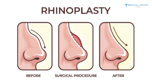 What are the Reasons Why Nose Surgery is Cheap in Turkey?
