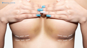 Why Breast Augmentations are Trending in 2026?
