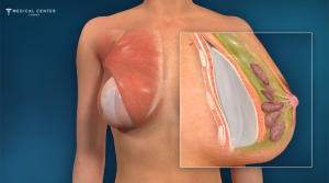 Why Breast Augmentations are Trending in 2026?