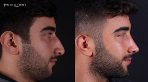 What are the Reasons Why Nose Surgery is Cheap in Turkey?