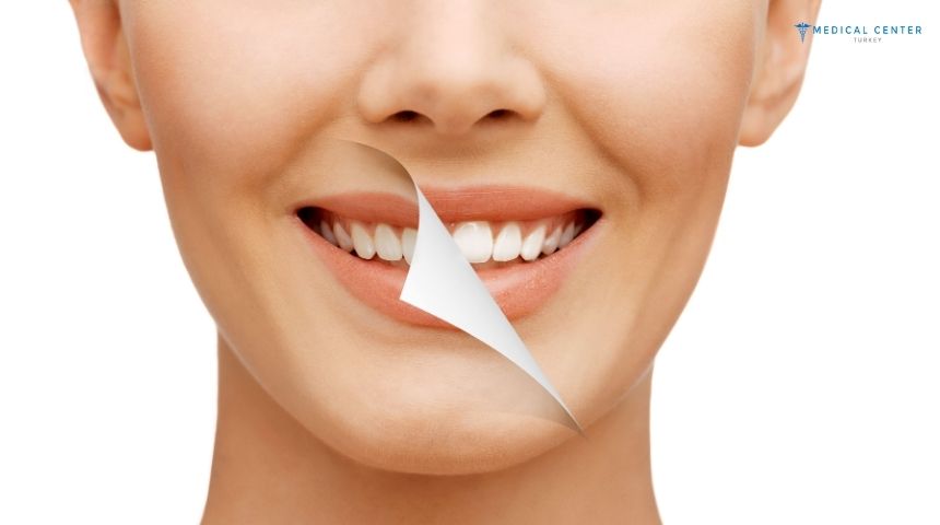 What to Know Before Getting a Dental Makeover in Turkey 2025 What to Know Before Getting a Dental Makeover in Turkey 2025