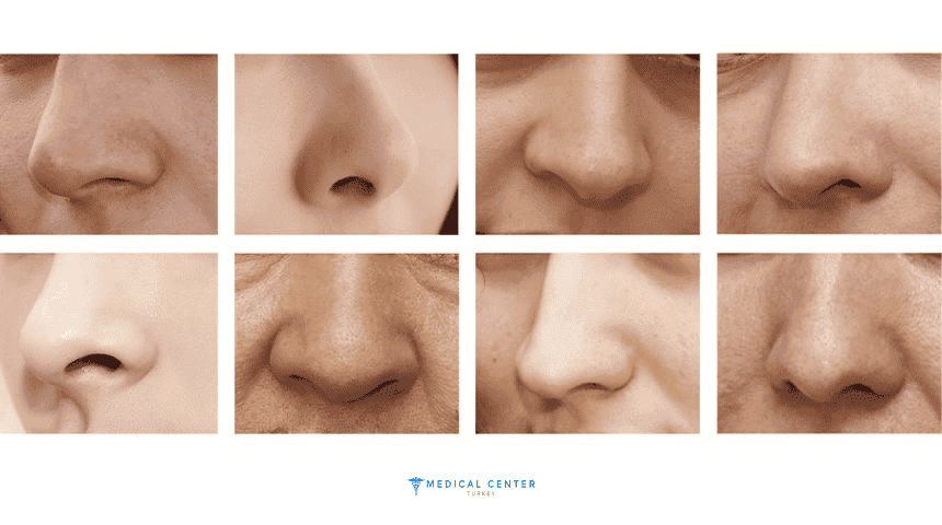 What Are the Differences Between Rhinoplasty Options in 2025?